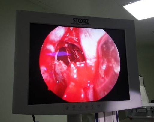 كربلاء: رفع ورم في الغدة النخامية من الدماغ  بالناظور وعن طريق الأنف