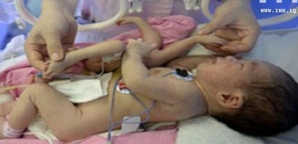 طفل يولد بـ 8 أطراف ووالده يحمل نفسه المسؤولية