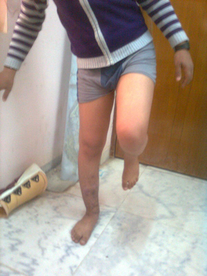 كربلاء: إعادة قطعة من عظم قصبة الساق بعد يوم من فقدانها اثر حادث دراجة تعرض لها احد الشباب(مصور)