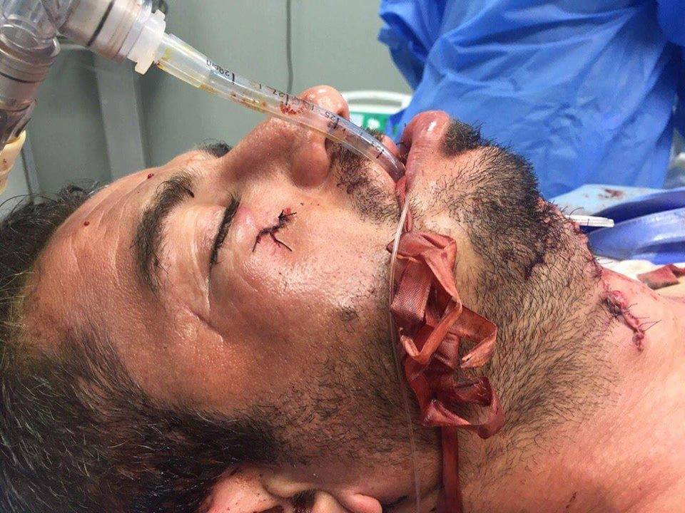 بالصور:جراحون كربلائيون ينجحون في تثبيت وترقيع كسور متعددة في وجه أحد مقاتلي الحشد الشعبي