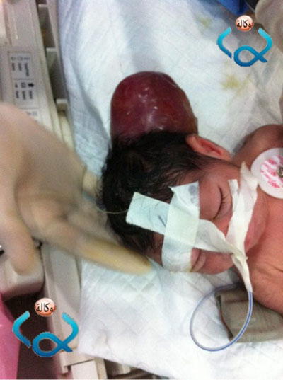 بالصور ولادة طفل برأسين في احد مستشفيات كربلاء المقدسة