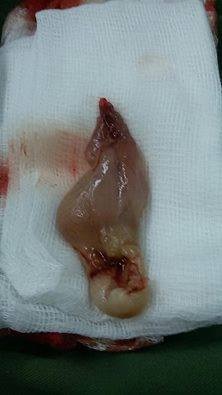 عاجل :عملية نادرة لاستئصال ورم في الجهاز التنفسي