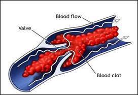 الجلطات الوريدية تزيد مخاطر الاصابة بالازمات القلبية