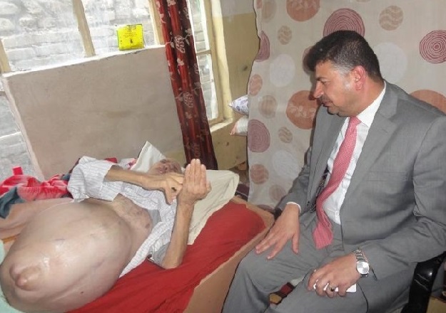 بالصور:ورم كبير يقدر بخمس وعشرين ( كغم ) في معدة  مواطن بصري والمحافظ يرسل وفدا لمتابعة حالته