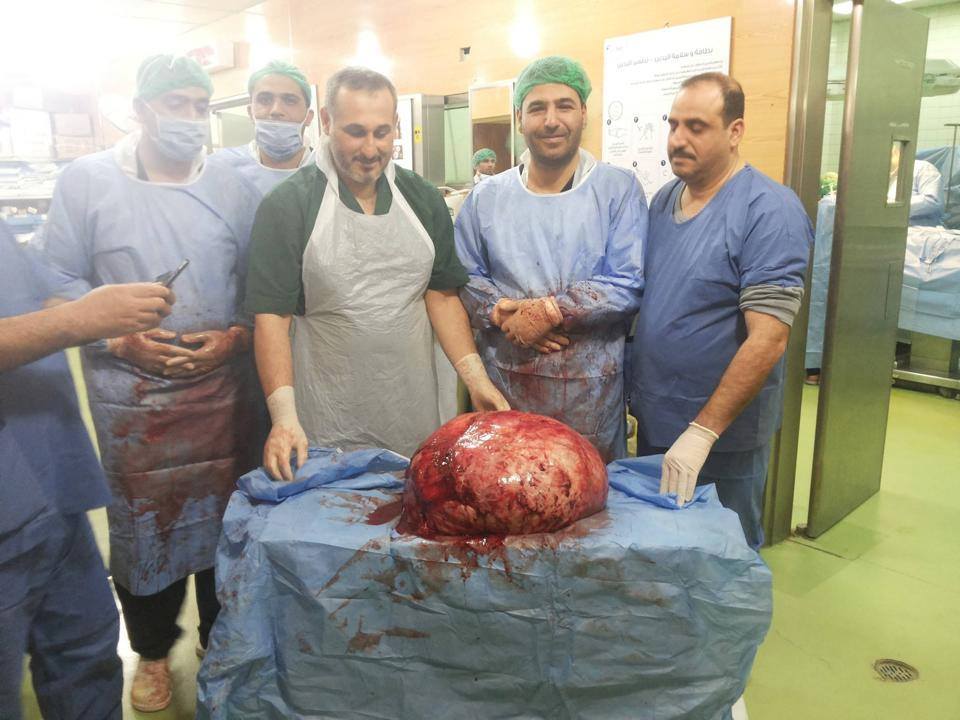رفع 32كغم من بطن امرأة بعملية فائقة الدقة والخطورة+صورة