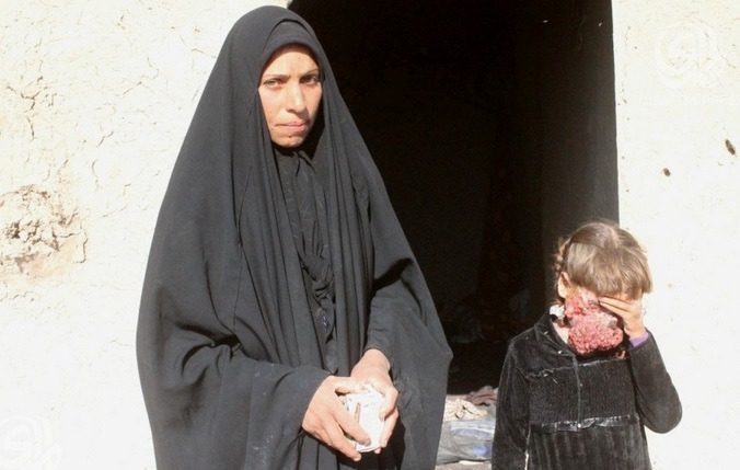 أم بالديوانية تضطر لعلاج وجه ابنتها بـ"مبيد حشري" لعدم تمكن الأطباء من علاجها