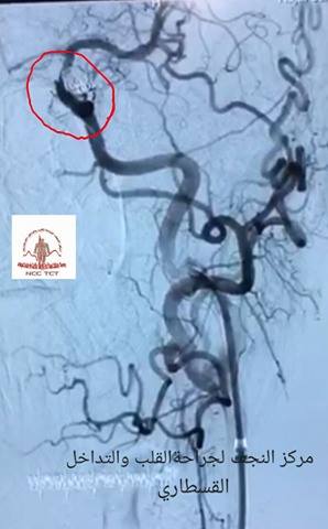 اجراء اول  عملية  قسطرة معقدة في مركز النجف للتداخل القسطاري والقلب  لغلق شريان  دماغي