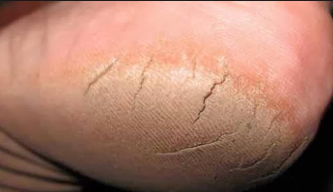 علاج سريع وبسيط لتشققات كعب القدمين