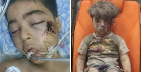 وفاة شقيق الطفل "عمران" الذي صدم العالم