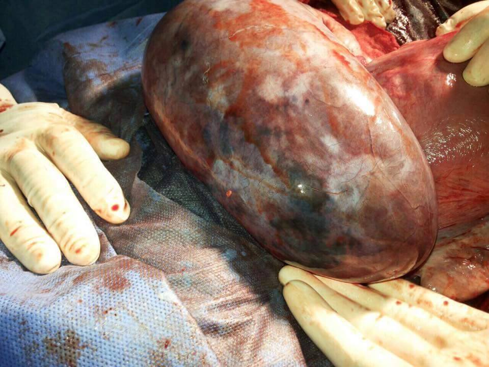 عملية جراحية تنقذ حياة مريضة كربلائية وتمكينها على الإنجاب مستقبلاَ