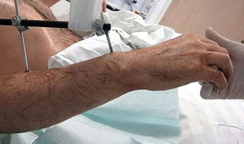 مستشفى ألماني يزرع أول ذراعين كاملتين في العالم