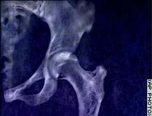 دراسة ضعف خطير في عظام الأطفال لنقص الكالسيوم والرياضة