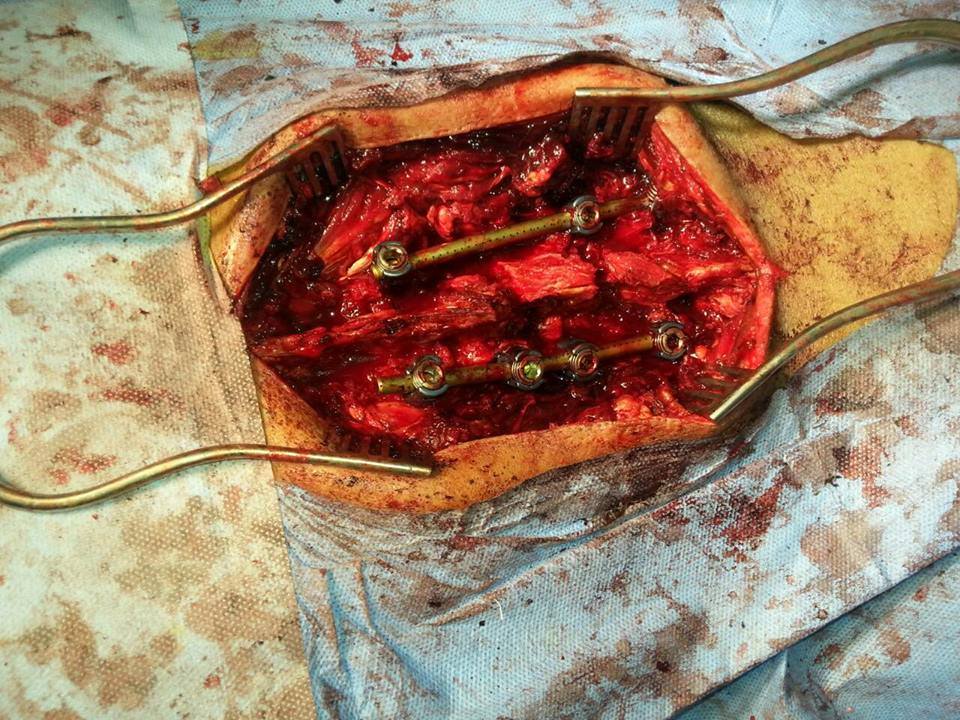 بالصور :نجاح اول عملية لتبيث الفقرات في مدينة الصدر الطبية في النجف