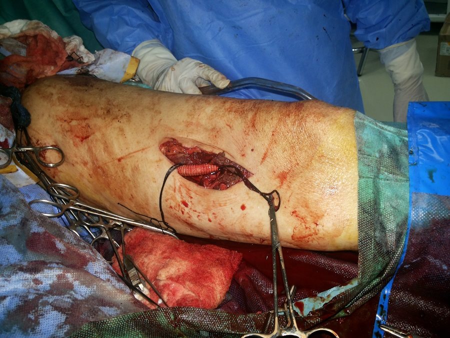 كربلاء:فريق طبي ينجح في زراعة شريان صناعي بطول 50 سم لقدم مصابة بـ (الكنكري) الاولى من نوعها