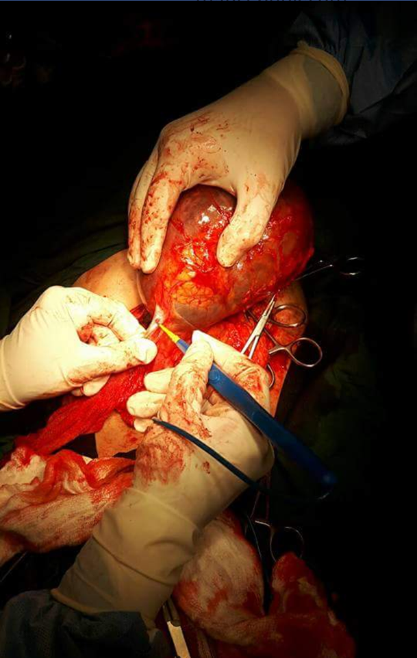 فريق طبي بكربلاء ينجح بإستئصال ورم " ولادي  "  وزنه ( 5 ، 1 ) كغم من بطن طفلة عمرها 11 عاما  (مصور)