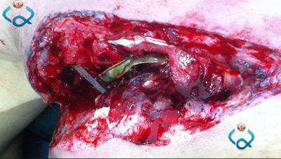 طبيب في كربلاء يكتشف لوبياء وخضروات واجسام غريبة داخل جرح احد المصابين بتفجير حي التحدي (مصور)