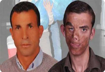 أول عملية زراعة وجه تتم في تركيا