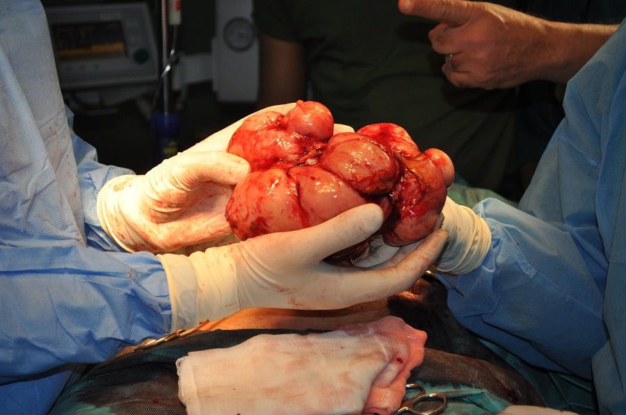 بالصور:استئصال ورم يزن (2) كغم من بطن سيدة كربلائية