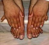 سوري  بـ«24 أصبع» يطمح بدخول «غينيس»!!