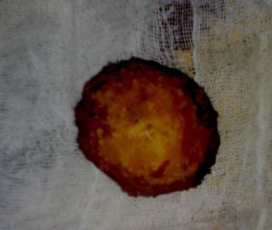 استخراج حصى بحجم 75 سنتمترا مربعا من مثانة مريض في كربلاء