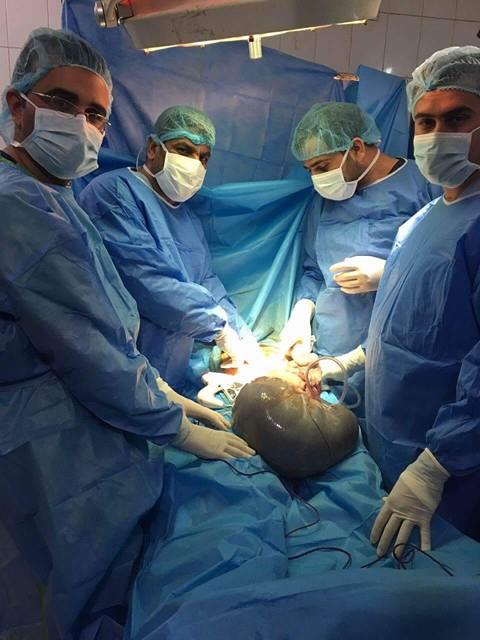 إستئصال ورم زنته ( 11 ) كغم من بطن مريضة سبعينية في مدينة الإمام الحسين ( ع ) الطبية بكربلاء