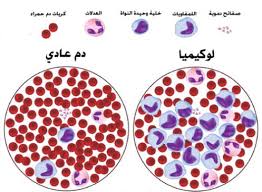مرضى ( لوكيميا الدم ) بلا دواء في كربلاء واولياء امور المرضى يهددون برفع دعوى قضائية ضد المقصرين