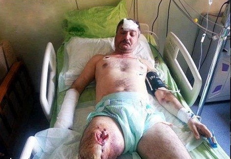 أول صورة لقائد الجيش الحر السوري المعارض في المستشفى ورجله اليمنى مقطوعة