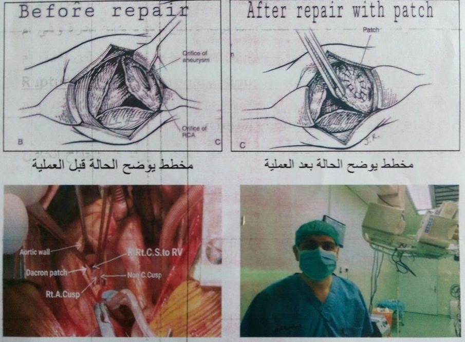 اجراء عملية نادرة و متميزة لاستئصال ام الدم مع غلق فتحة بين الجيب التاجي و البطين الايمن في مركز ابن البيطار لجراحة القلب