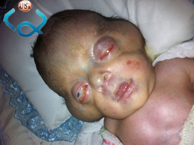 بالصور:ازدياد حالات الولادات المشوهة في محافظة كربلاء