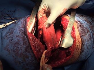 عاجل: استئصال مريء وتصنيعه بإستخدام اجزاء من المعدة