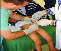 للمرة الأولى: محكمة ألمانية تعتبر ختان الذكور جريمة إيذاء للجسم