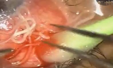 بالصور:أطباء عراقيون يخرجون دودة خيطية من عين أحد المصابين