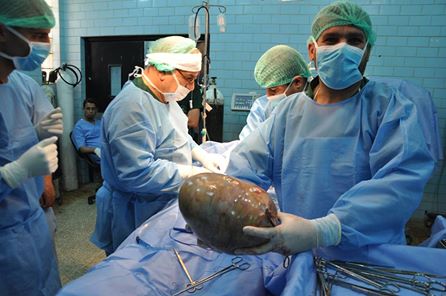 بالصورة :فريق طبي ينجح باستئصال ورم يزن "6"كغم من جوف سيدة