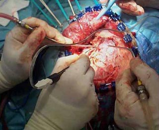 اجراء اول عملية جراحية لرفع كيس دماغي  في كربلاء