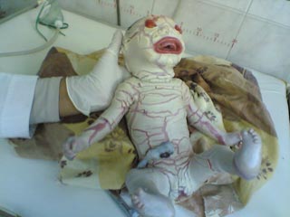 مستشفى النسائية والتوليد  في كربلاء يشهد ولادة طفلة لها خطوط النمر بدلا من جلدها