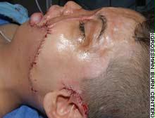 الطفل يوسف يتعافى بعد معاناة من العملية الجراحية