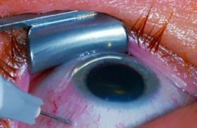 يابانيون يبتكرون عيناً صناعية تعطي أمل لفاقدي البصر!!