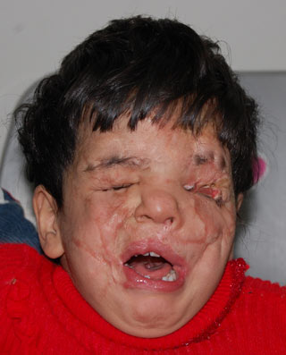 العتبة الحسينية المقدسة تتكفل بعلاج الطفلة (شمس هشام العبيدي)  خارج العراق