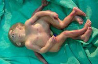 ولادة طفلين توأمين ملتحمين وبرأس واحد في محافظة ميسان جنوب العراق