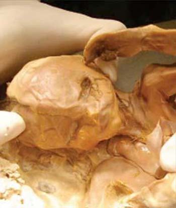 طفلة متحجرة خارج رحم امها ومدة الحمل اربعون عاماً !