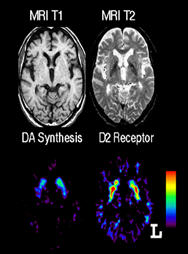 اكتشاف قد يقود إلى علاج عوارض مرض باركنسونز
