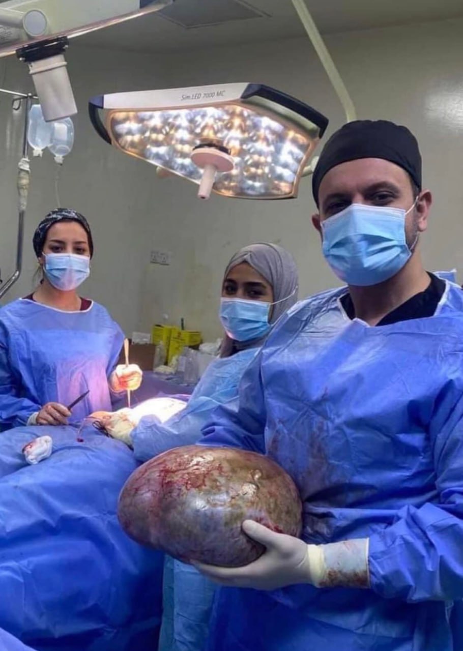 في مستشفى الكندي التعليمي في ببغداد.. فريق طبي يرفع ورم وزنه (١٠) كيلوغرام من جسد مريضة