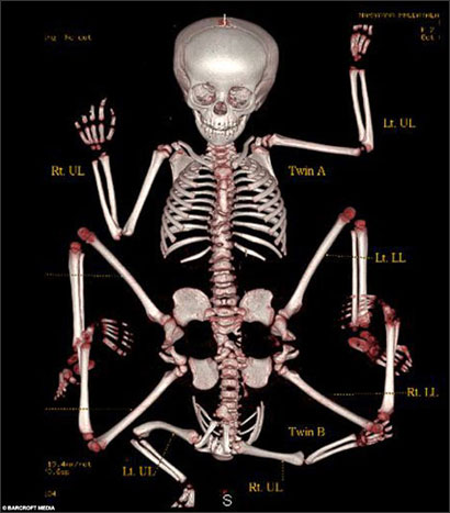 طفلة بأربع كلى