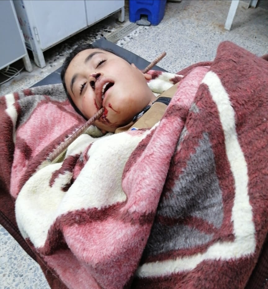 بالصور: سيخ حديدي " يخترق وجه طفل بكربلاء ويخرج من إذنه اليُسرى وفرق طبية تُنقذه