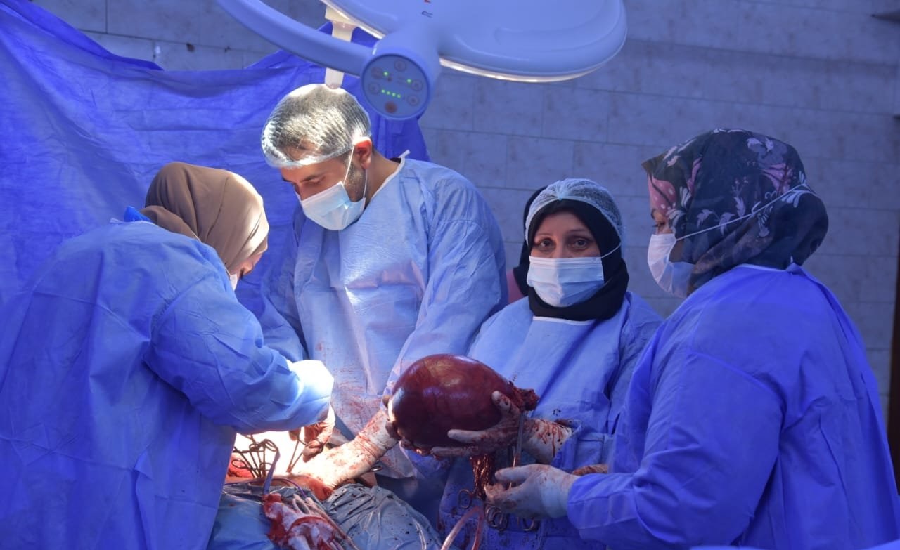 فريق طبي ينجح بإزالة ورم كبير من بطن امرأة في كربلاء