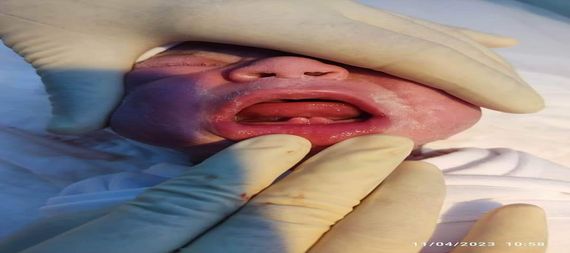 ولادة طفل باسنان لبنية في مستشفى ناحية الشوملي جنوب الحلة