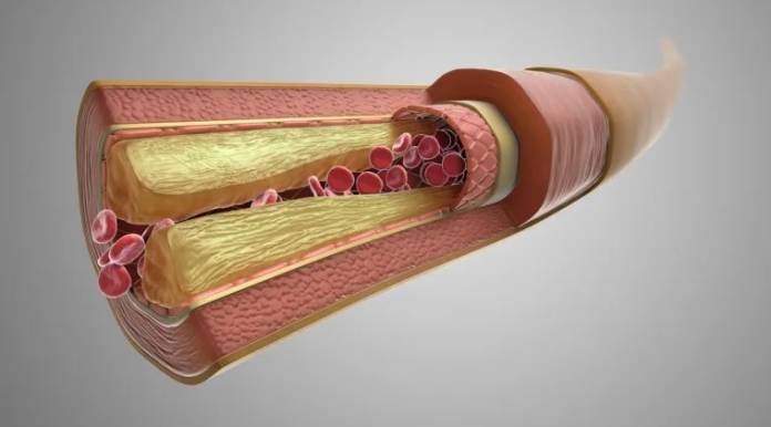 هل يمكن تنظيف الشرايين من الكوليسترول؟