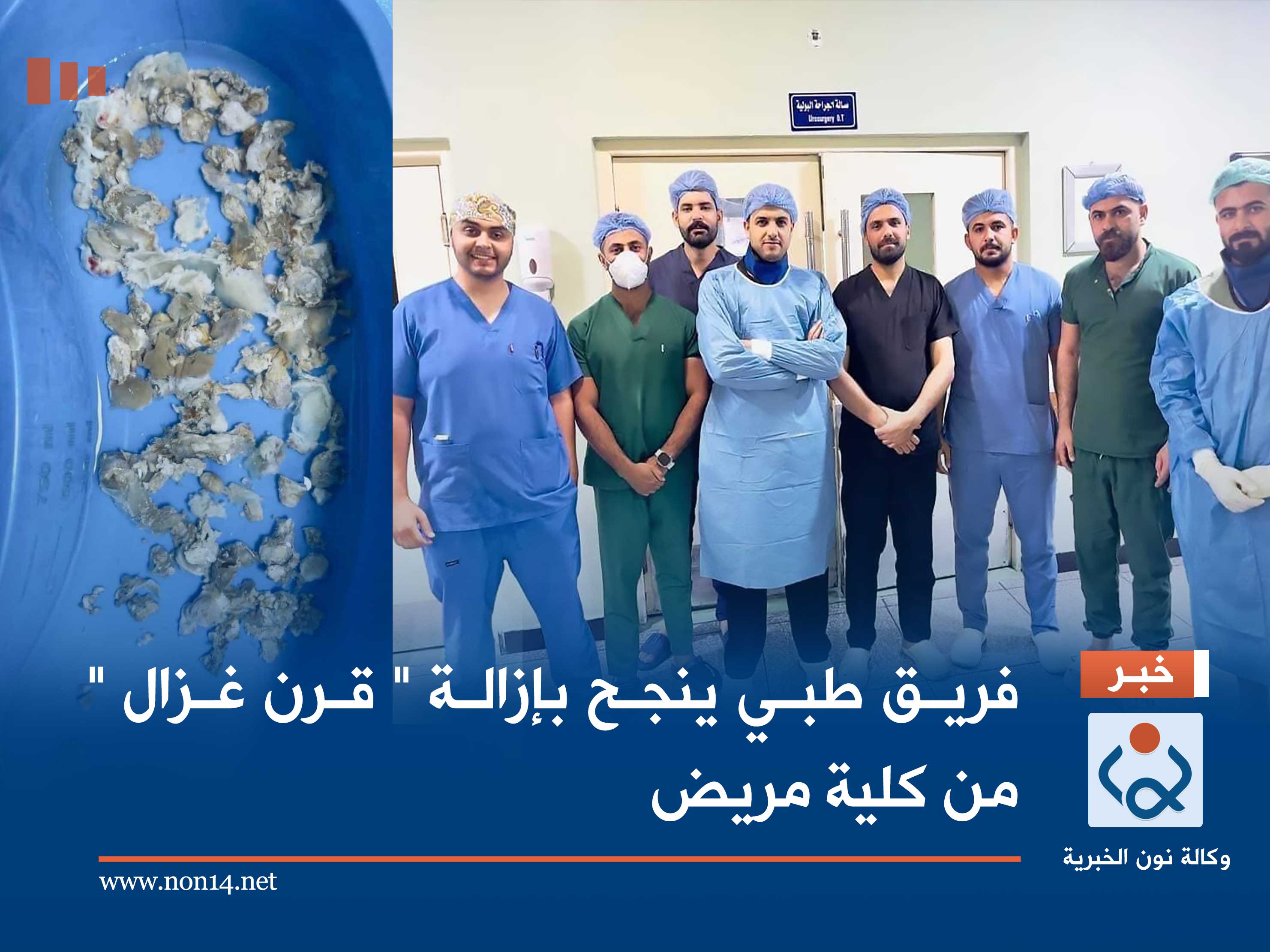 فريق طبي ينجح بإزالة " قرن غزال " من كلية مريض