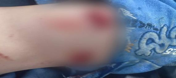 ذئب يهاجم طفلا ويصيبه بجرح عميق في يده باحد اقضية واسط