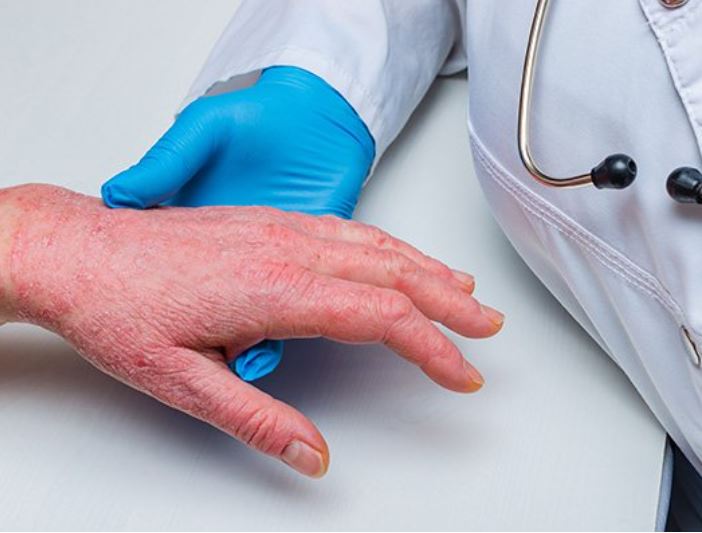 تسجيل اول اصابة بجدري القردة في المملكة المغربية